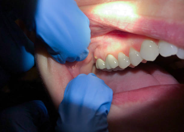 Best Emergency Treatment for Dental Infections or Abscesses in Paducah, TX