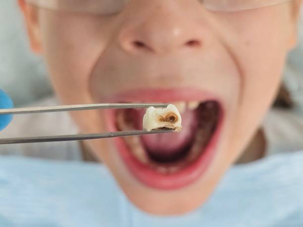 Best Emergency Wisdom Teeth Removal in Paducah, TX